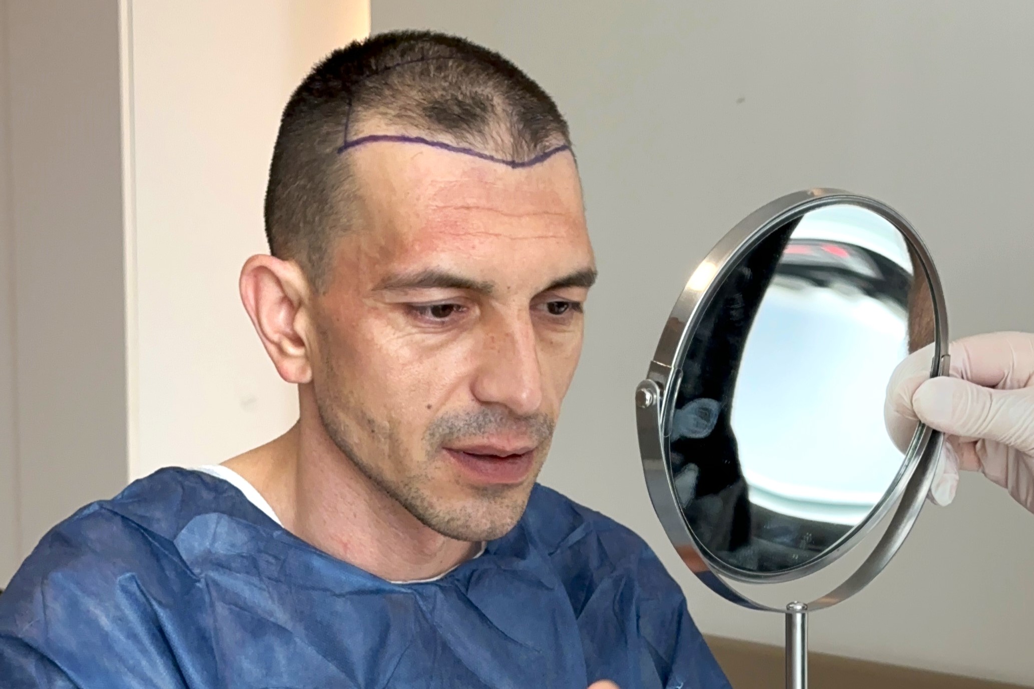 Revolutionizing Hair Restoration: The Benefits of DHI Hair Transplant